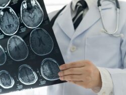 Awas Stroke, Hindari 5 Kebiasaan Ini Supaya bisa Tetap Sehat