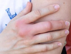 Waspada, Ini 5 Tanda Kerusakan Ginjal yang Terlihat di Kulit