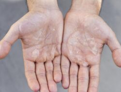 Ternyata Ini 5 Dalang Tangan Berkeringat Berlebihan